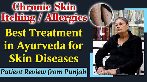 Chronic Skin Itching/ Allergy, Skin Diseases- Best Treatment in Ayurveda