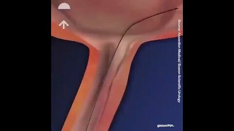 How doctors remove kidney stones