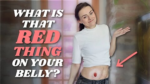 What is a Stoma / Ostomy? (That Red Thing Hanging Out of My Belly!) | Let's Talk IBD