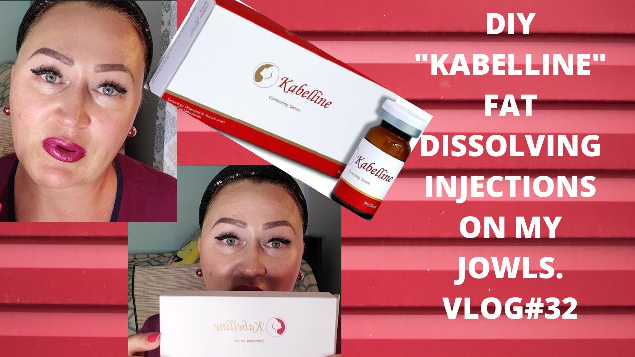 DIY KABELLINE FAT DISSOLVING INJECTIONS ON MY JOWLS. USE DISCOUNT CODE NAT10