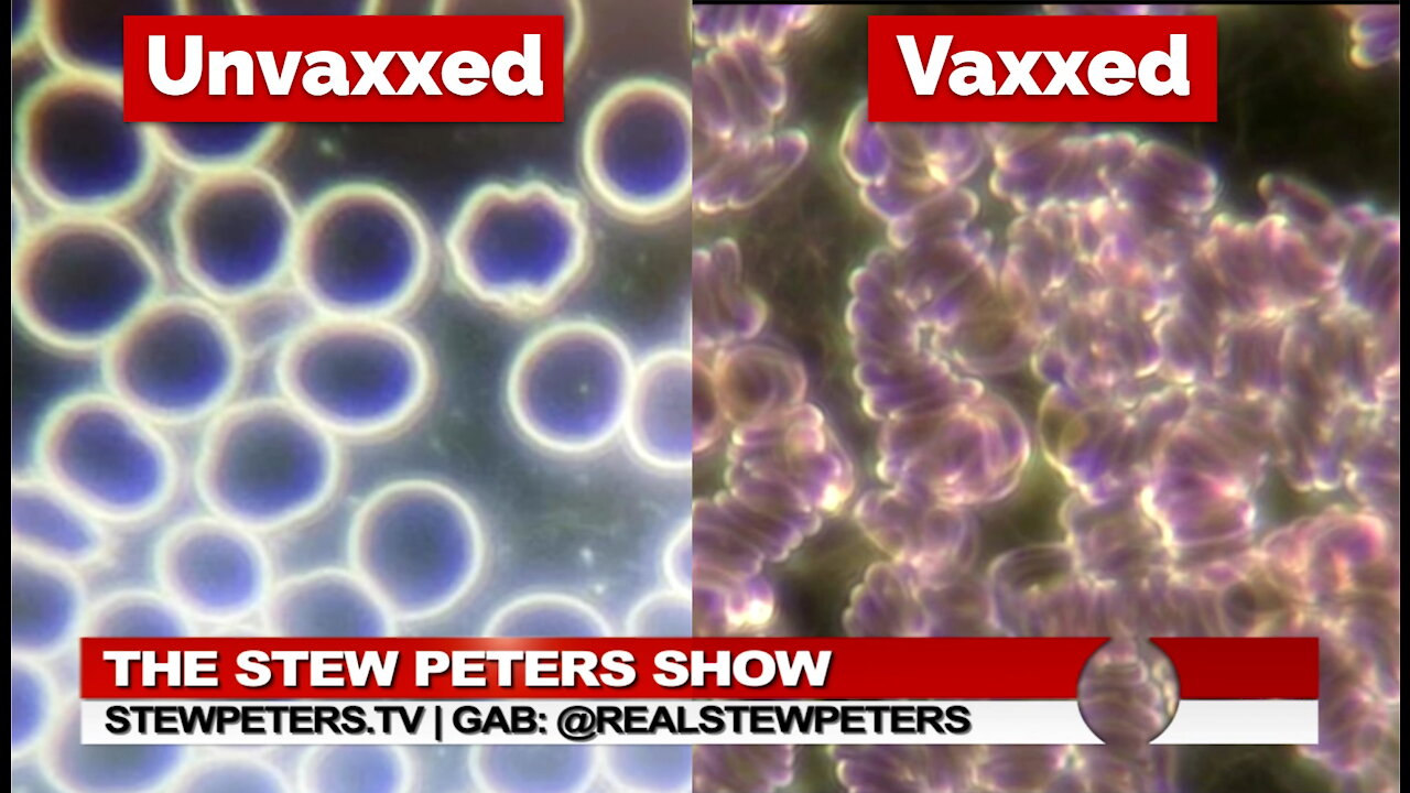 Dr. Zandré Botha's analyses of vaxxed patients' blood show clumping red cells, non-viable white cells