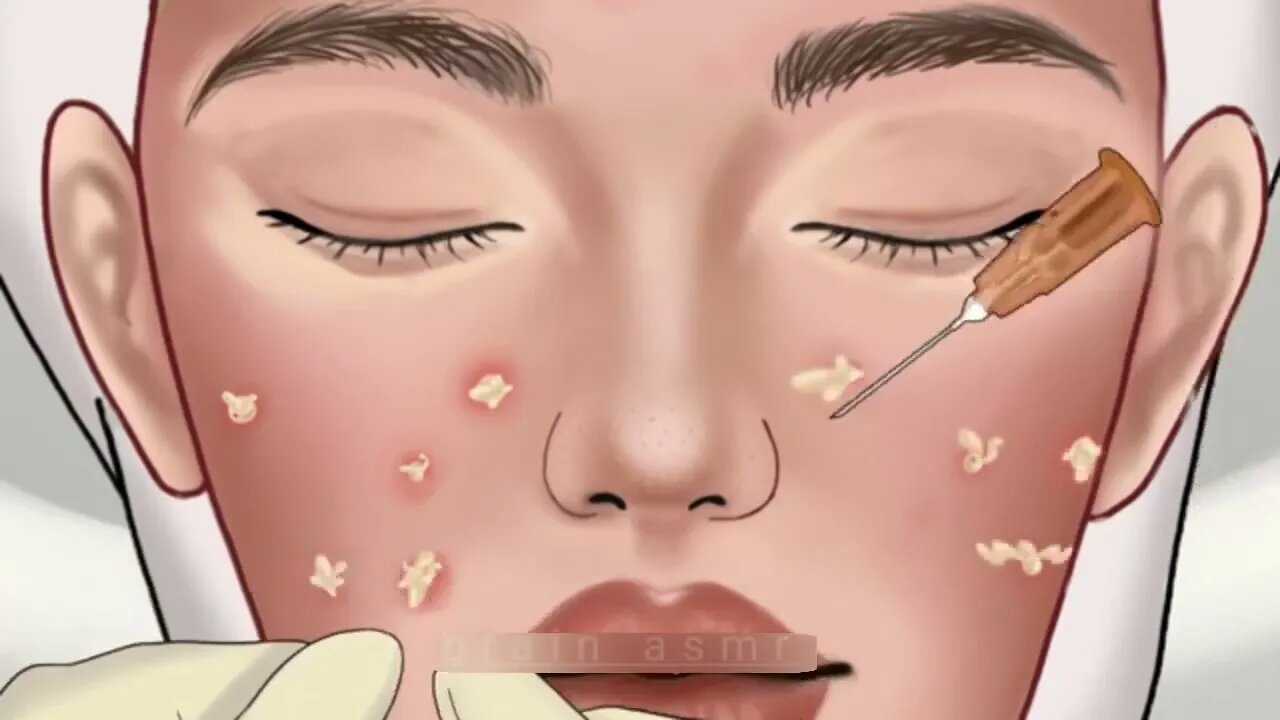 ASMR Treatment of blackheads and hidden acne processing | @SatisfyingASMRanimation