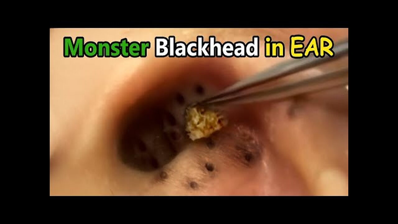 UNBELIEVABLE AMOUNT OF EARWAX EXTRACTEDIA