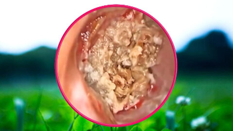 Ear Wax Removal With Clam Relaxing Music #44