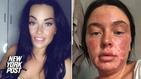 Botched TikTok egg hack leaves woman with 'poached' face
