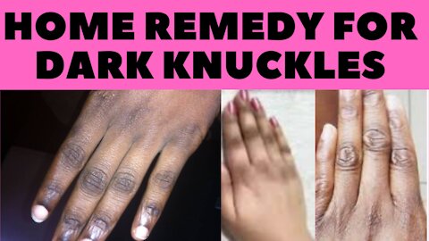 Top 7 Home Remedies For Dark Knuckles You Should Try To Get Beautiful Hands