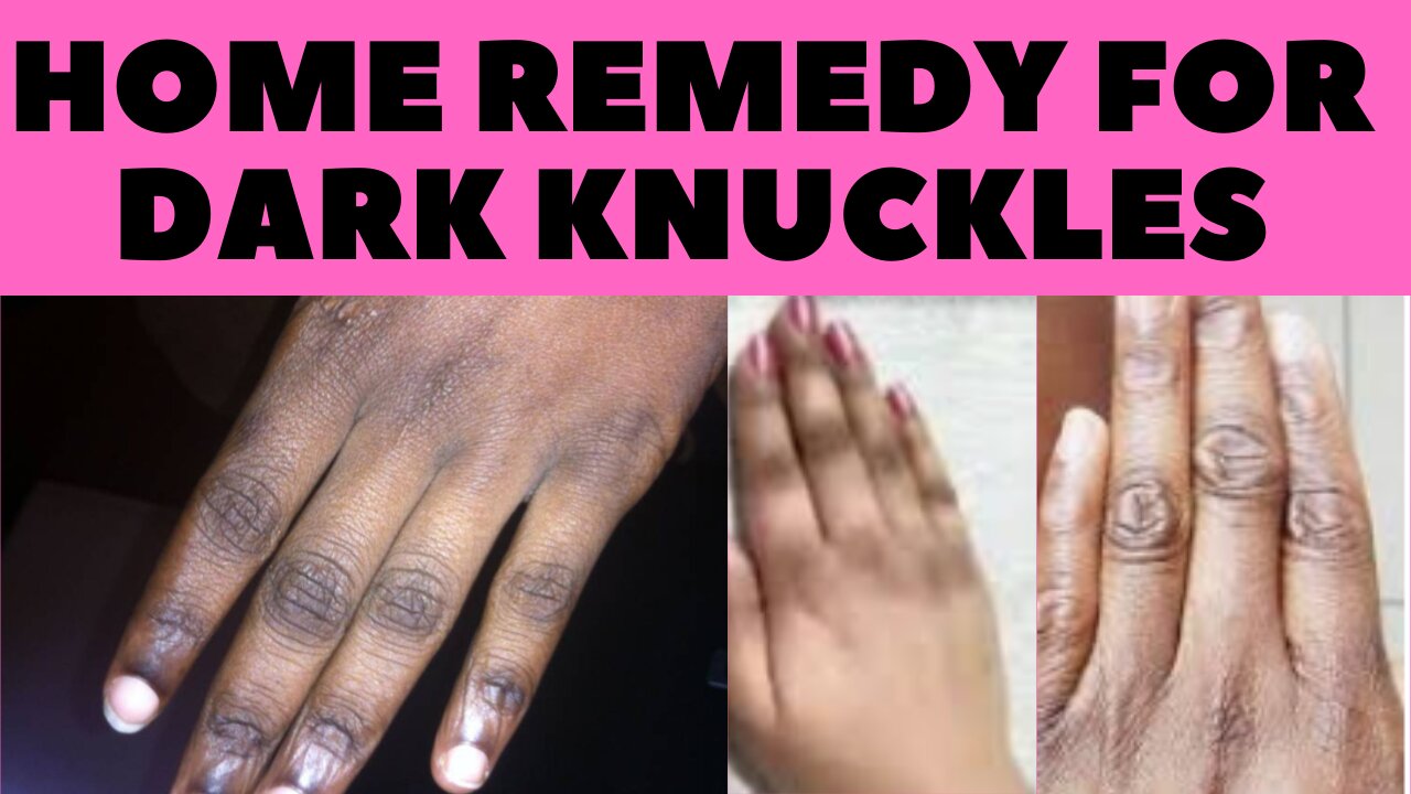 Top 7 Home Remedies For Dark Knuckles You Should Try To Get Beautiful Hands