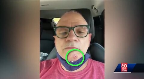 Monkeyhoax vax ain´t so "Safe & Effective" (Where we´ve heard that one before?)