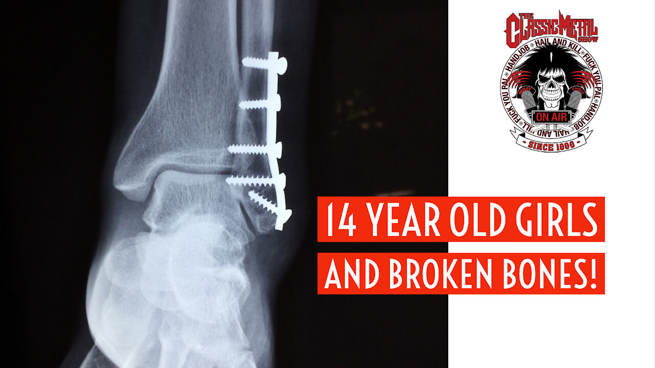 CMS | 14 Year Old Girls and Broken Bones