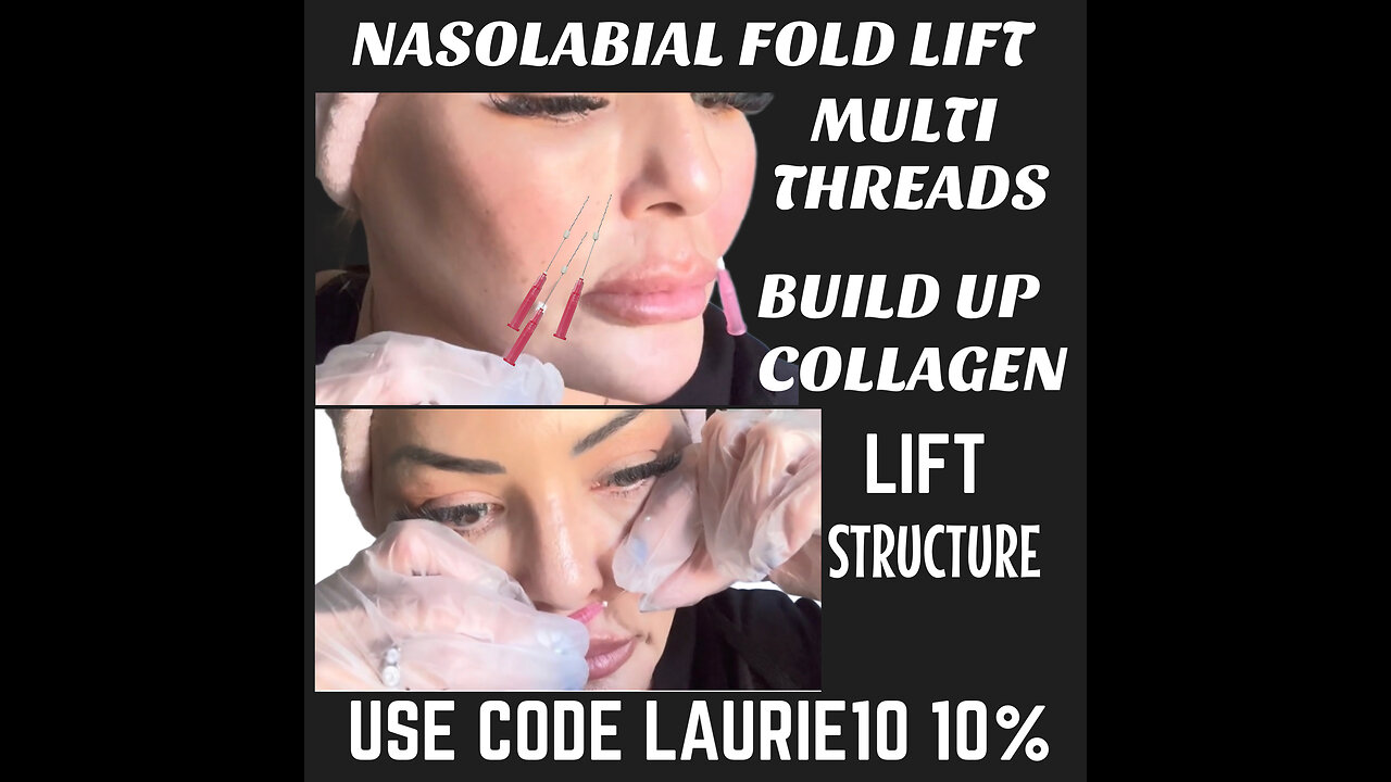 Lifting Nasolabial Folds And How I Keep My Face From falling
