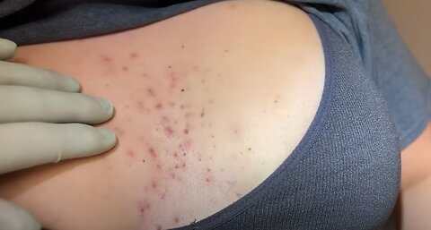 Tons of blackheads on the back. Acne extractions. Blackheads and whiteheads. Mining pore dirt. EP5