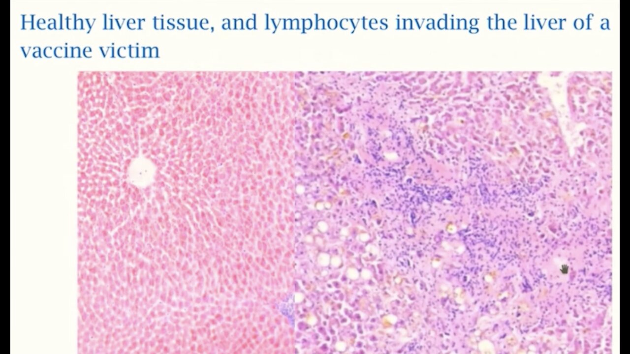 Vaccinee Autopsies: Killer Lymphocytes Invade Vital Organs, Drs Sucharit Bhakdi & Michael Palmer