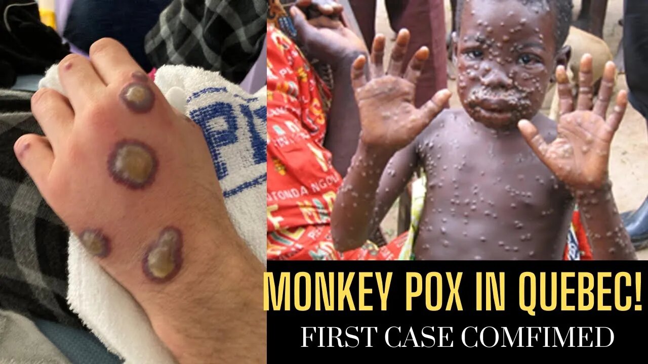 First Case of Monkey Pox Confirmed in Quebec