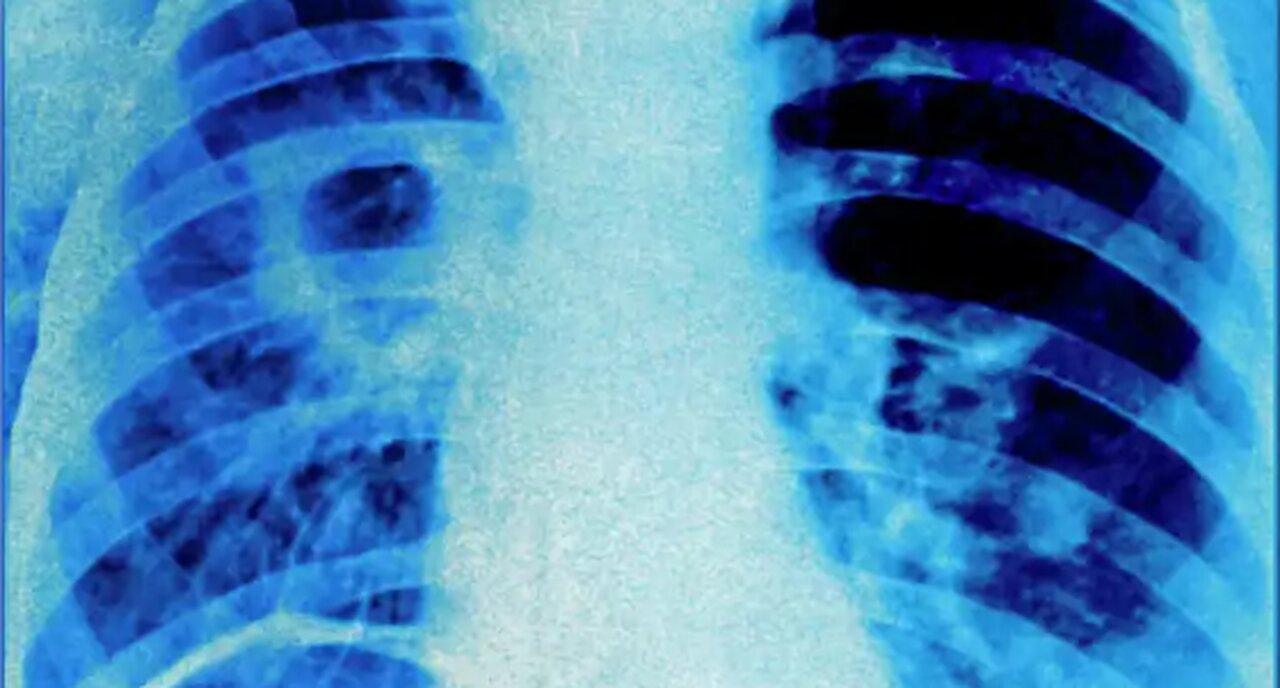 Special Report: UC Davis Starts Contact Tracing to Prevent Outbreak! Get Your Nano Silver: 12.24.23
