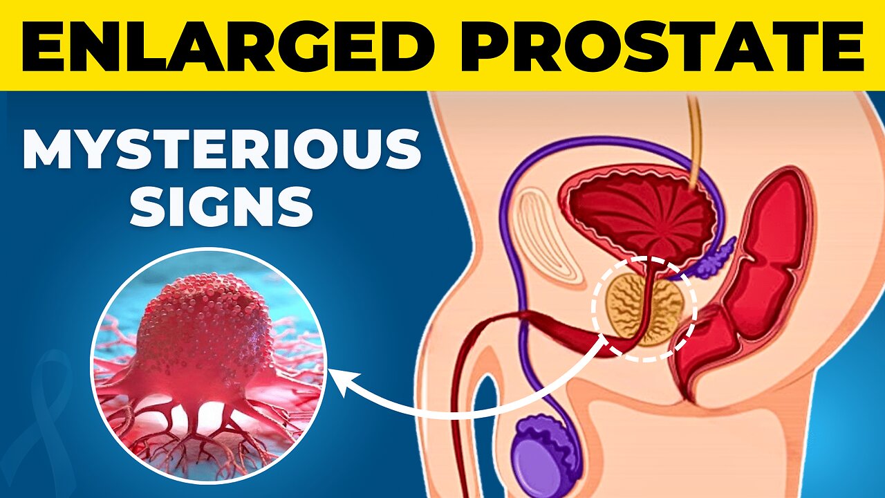 Enlarged Prostate (BPH) - Unknown Signs & Symptoms (DON'T IGNORE) Enlarged Prostate Treatment