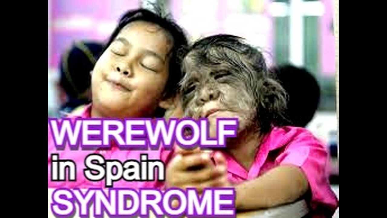 Werewolf Syndrome