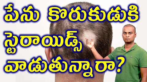 పేను కొరుకుడుకి స్టెరాయిడ్స్ వాడుతున్నారా? Alopecia Areata Totalis Universalis Homeopathy Treatment