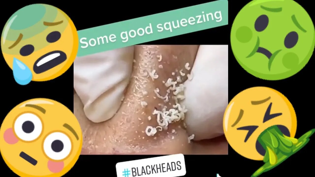 Some good blackhead squeezing 😅🪱 #blackheadremoval #blackhead #blackheads #blackheadsqueezing #fypp