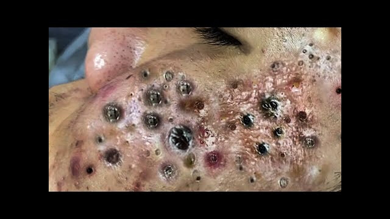 Skincare Blackhead Removal