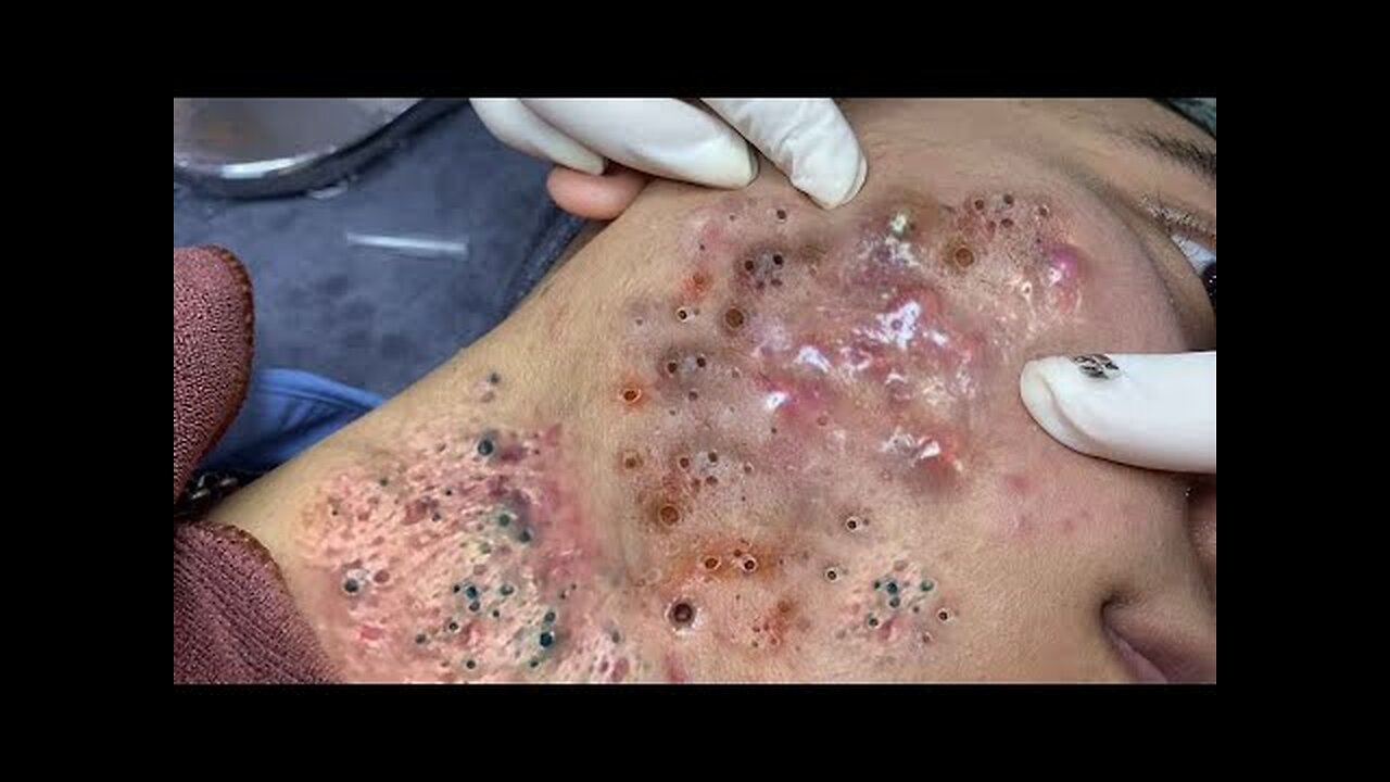 Satisfying blackhead Whiteheads removal relaxing PimplePopper Extraction 5563