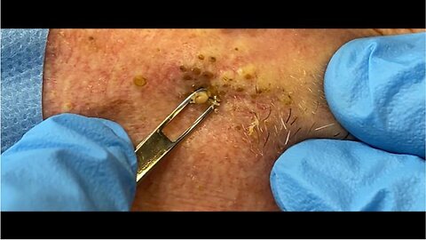 Extreme Blackhead Extraction