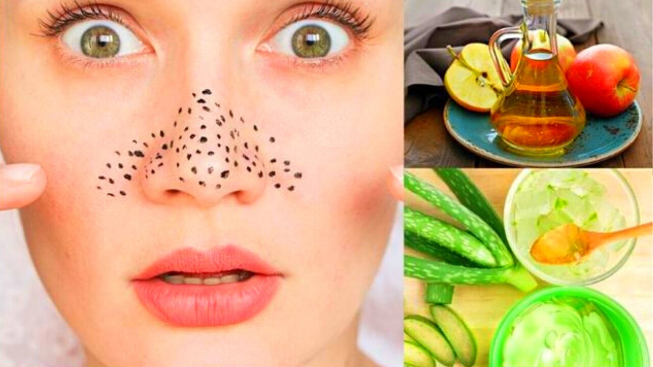 How to Remove Blackheads Naturally