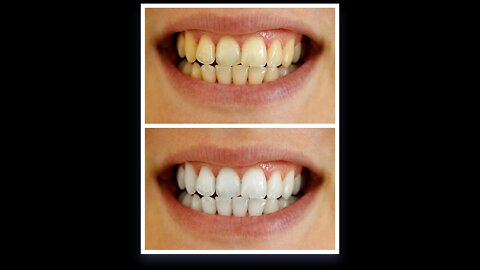 Whitens Teeth Up To 6 Shades In Less Than 16 Minutes...