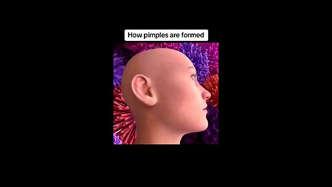 How Pimples are Formed