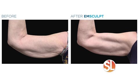 Contour Medical can help save those saggy arms