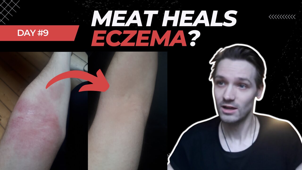 2 Months on the Carnivore Diet - Did it heal my eczema?