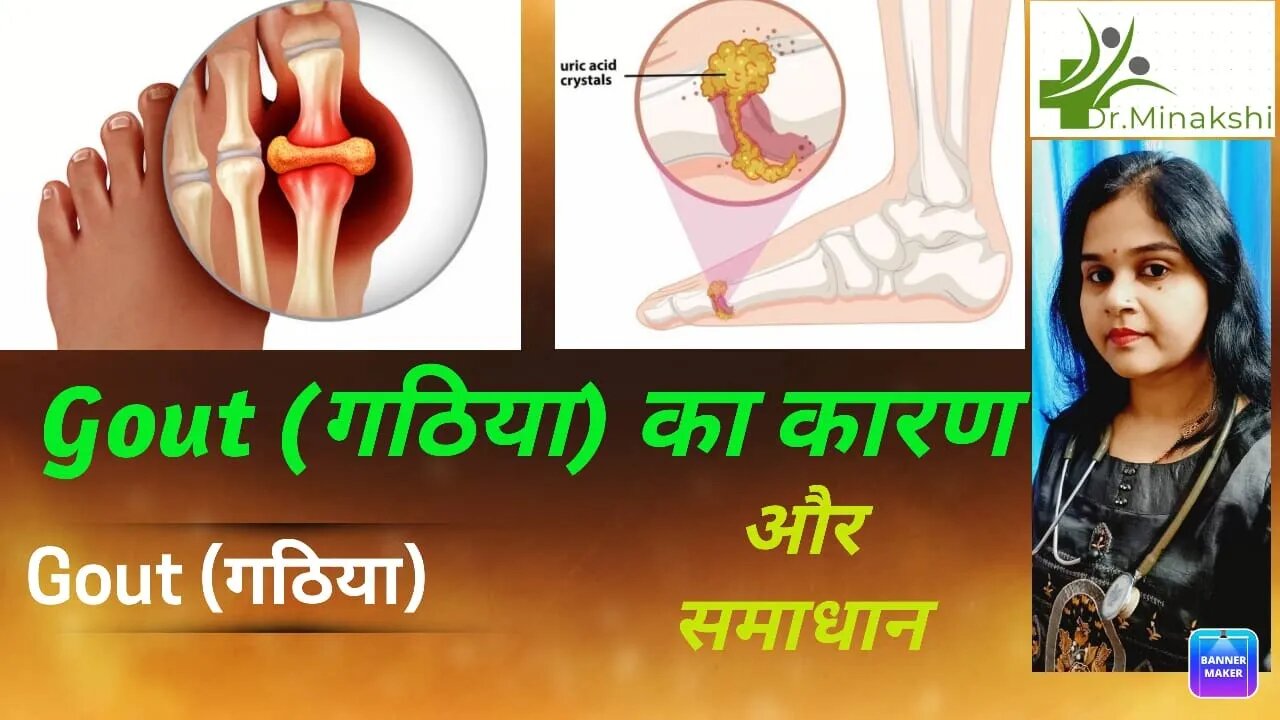 Gout (गठिया) कारण और उपचार|| uric acid badne me kya kare