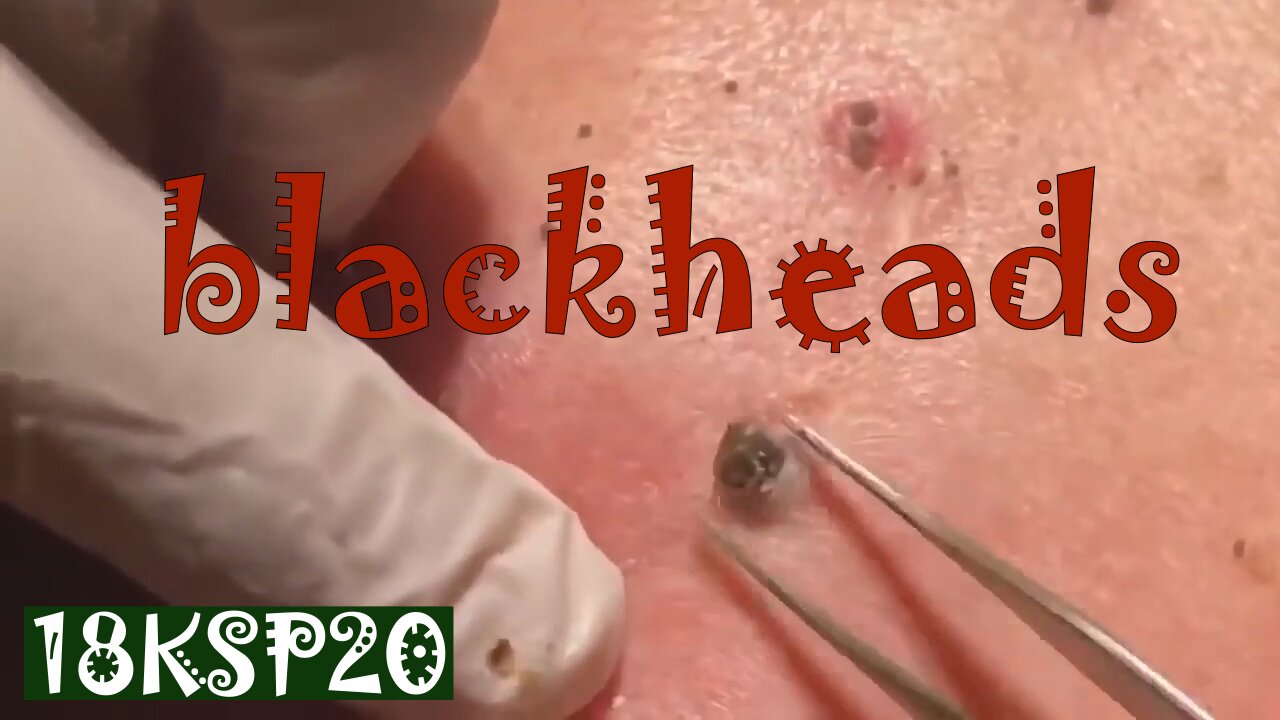 Horrible Blackheads