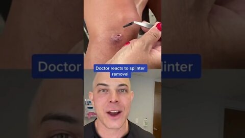 Huge splinter removal!