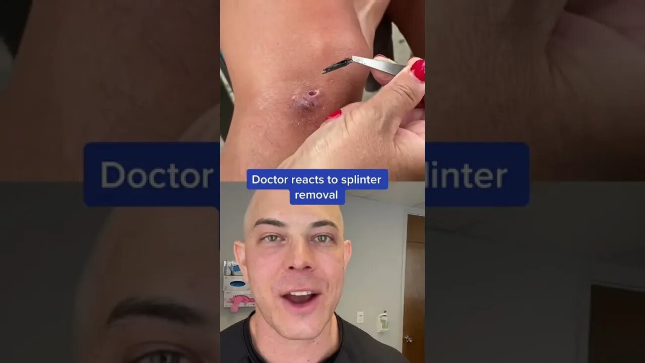 Huge splinter removal!