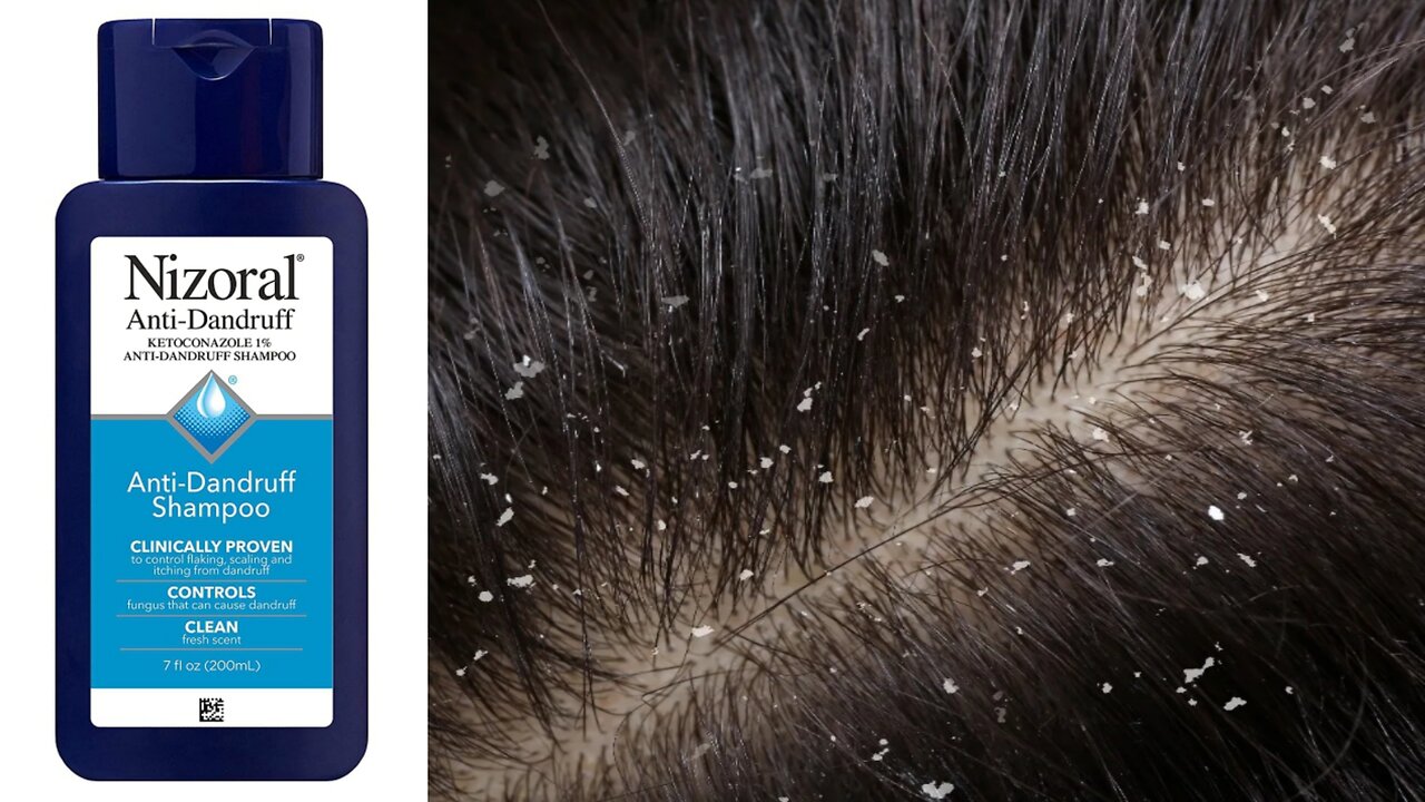 dandruff treatment at home