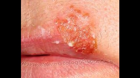 Tired of Cold Sores That Don't Go Away?