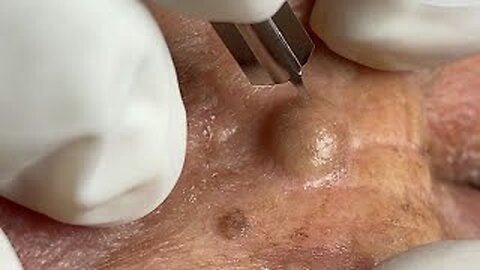 Super Big Acne blackhead removal pimple Popper