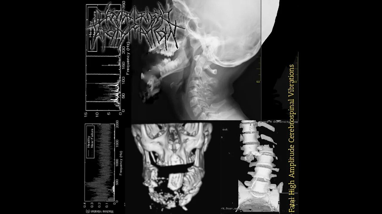 Centrifugal Atomization - Fatal High Amplitude Cerebrospinal Vibrations (Full EP)