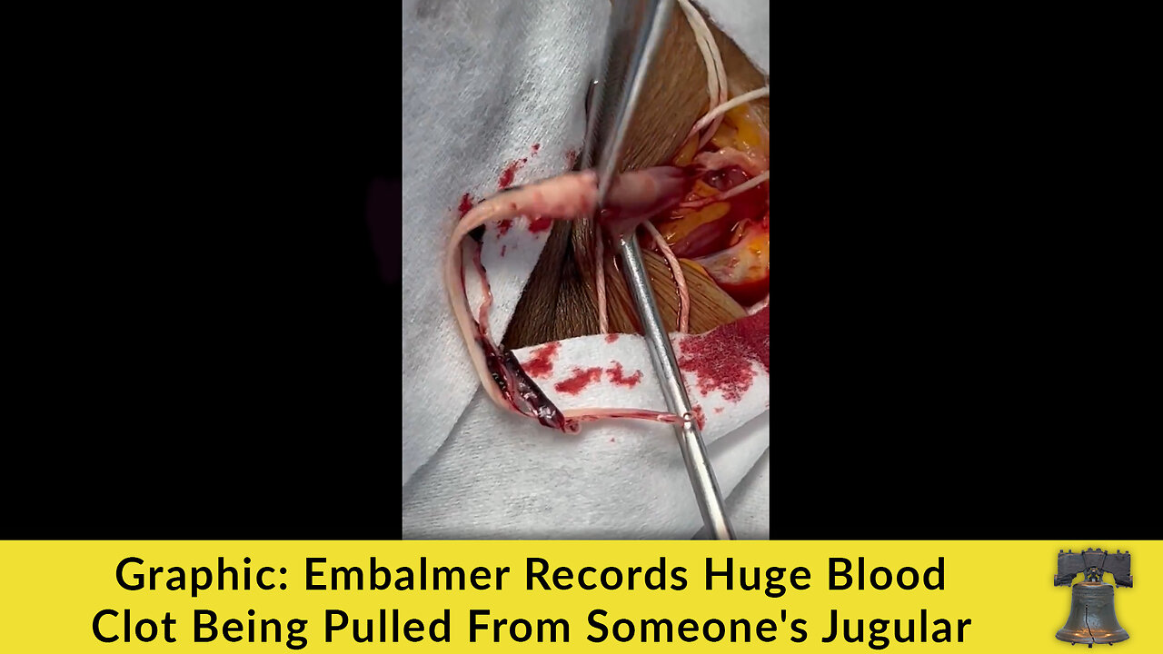 Graphic: Embalmer Records Huge Blood Clot Being Pulled From Someone's Jugular