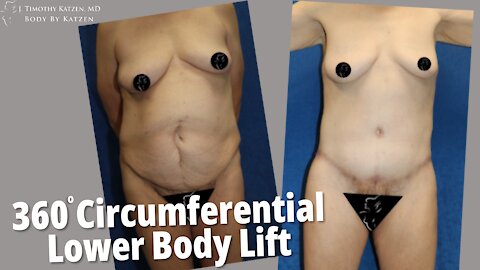 360° Circumferential Lower Body Lift