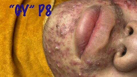 Big Cystic Acne Blackheads Extraction Blackheads & Milia, Whiteheads Removal Pimple Popping 13
