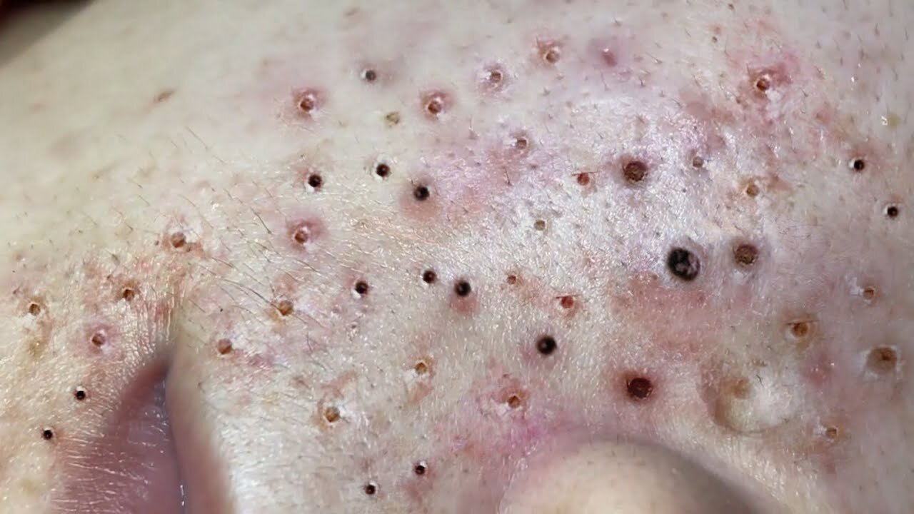 blackhead removal / acen klin