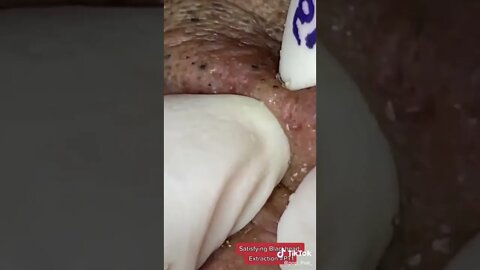 Extremely satisfying blackhead extraction 😳🫣 #blackheadremoval #blackhead #blackheads #satisfying