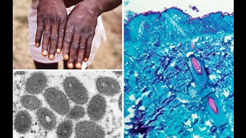 MonkeyPox: WHO Convenes Emergency Meeting; First Case in NYC