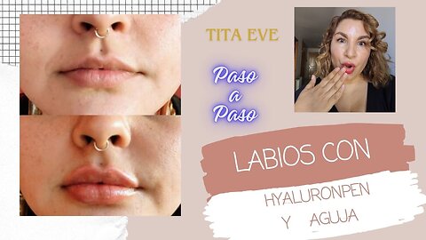 HYAFILL LABIOS CON HYALURON Y AGUJA Paso a Paso