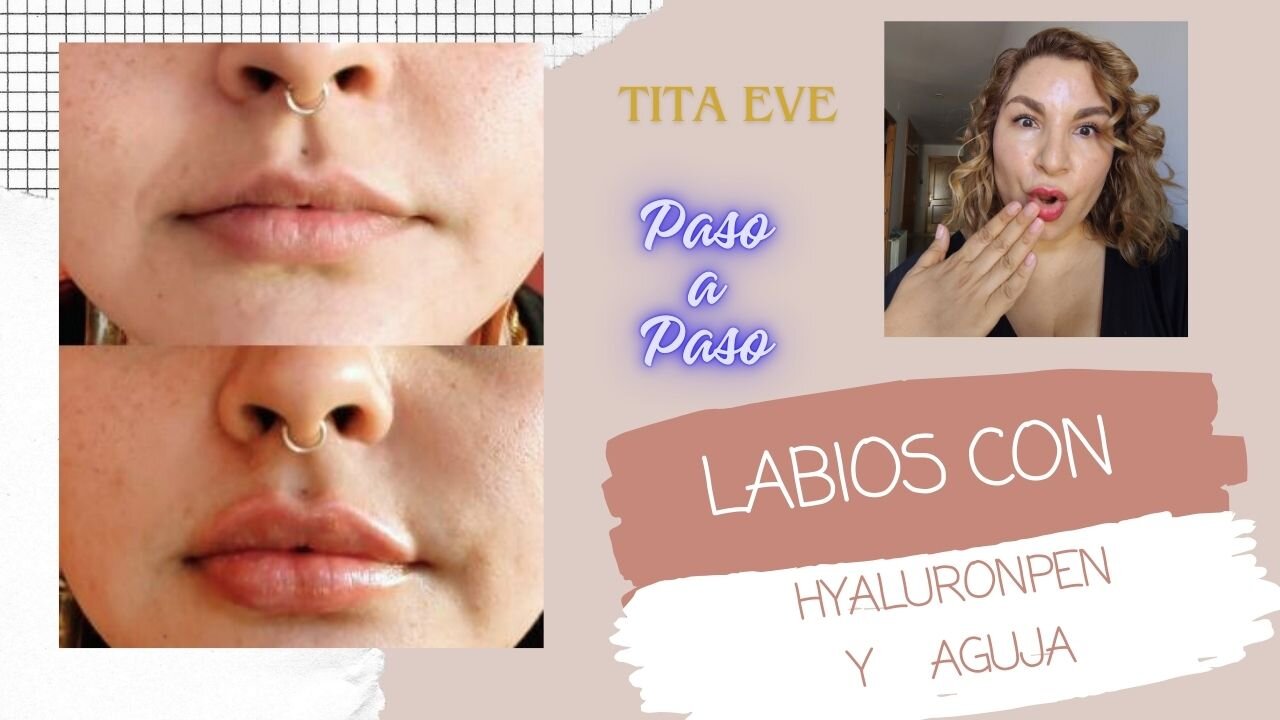 HYAFILL LABIOS CON HYALURON Y AGUJA Paso a Paso