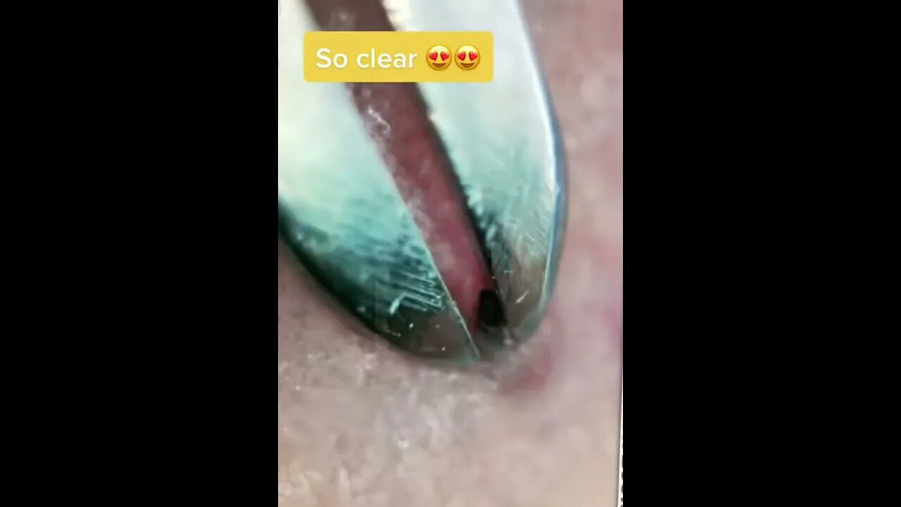 Zoomed Ingrown Hair Removal