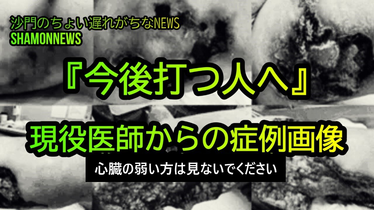 『今後打つ人へ』現役医師からの症例画像(沙門のちょい遅れがちなNEWS)