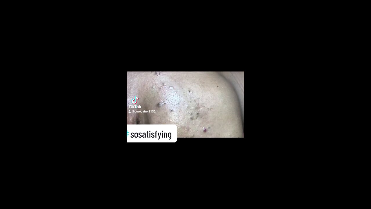 So Satisfying Blackheads removal!