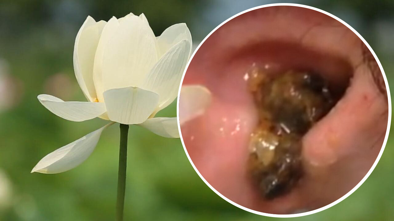 Earwax Cleaning With Relaxing Sound Part-9